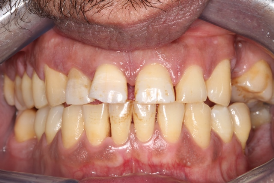 Open apex management - Procedure photo Case 4